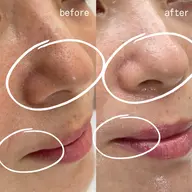 フェイスワックス！美肌爆弾HARIパック付き✨フェイスワックスでしか手に入らないツルツル素肌を体感してくださいませ🤭