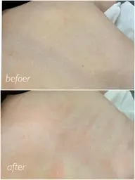 背中or腰シュガーリング