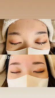 ハリウッドブロウリフト