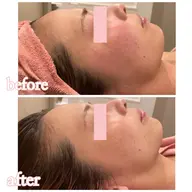 剥離あり🍃100%天然ハーブピーリング🍃植物幹細胞×ヒト幹細胞培養液配合!シミ・ニキビ・タルミ・しわなどの悩み解消✨