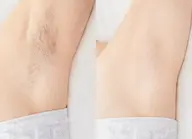 【美肌脱毛】選べるSパーツ/1部位お試し¥2,500→¥980