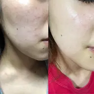 モニター価格 赤みケア