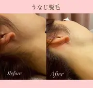 ✨🌷【初回限定価格】うなじ脱毛🌷✨