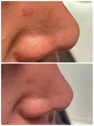 【ミニモ学割】気になる小鼻つるんっ!✨超音波毛穴洗浄