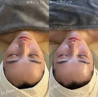 『フェイシャル 話題の水光ジェット🫶🏻』お肌の乾燥コース🫧乾燥の季節にピッタリ(ダウンタイム＋痛みなし)