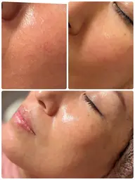 極上美肌リセットコース