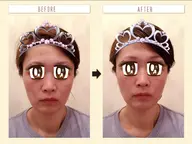 フェイシャル クイックリフトアップ