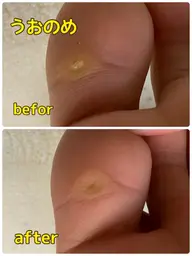 【大人気メニュー】魚の目取り放題コース♪（隠れた魚の目まで綺麗に取らせていただきます）