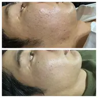 【とにかく肌を綺麗にしたい人ミニモ学割】ハーブピーリング+毛穴洗浄