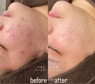 [ニキビ、ニキビ跡お悩みの方]韓国産🇰🇷剥離アリハーブピーリング🌿