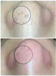 [次回予約]毛穴エクストラクションモンロー式