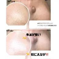 【超話題🌿剥離ナシ‼️】二刀流ハーブピーリング☆モニター様募集☆