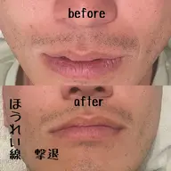 ミニモ限定メニュー✨美容鍼🔥ほうれい線に特化🔥針＋矯正マッサージ💆