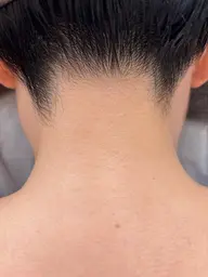 イオン導入顔脱毛＋襟足脱毛（無料シェービング付）