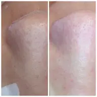 【モニター様】毛穴汚れ根こそぎ洗浄✨6800円→4000円！デコルテリンパ+美白パック付き☆透明感ある艶肌のへ