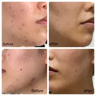 脱ニキビモニター☀️2ヶ月分のエステとスキンケア💆‍♀️