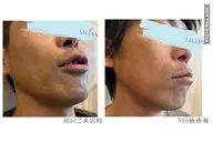 【men'sメニュー】お試し　ヒゲ脱毛　2回分