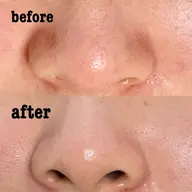 【フェイシャル毛穴ケア】ウォーターピーリング✖️ヒト幹細胞培養液ポレーション導入