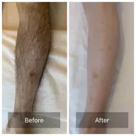 【メンズ脱毛】脚脱毛 夏までにツルツルな脚になって短パンを履きこなそう!