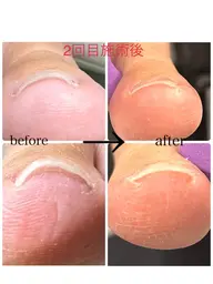 巻き爪ケアをしながらジェルアート❣️巻き爪矯正１本&ワンカラー¥5,500！！✨