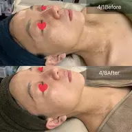 人気No.1【毛穴開き/加齢肌/たるみ/シミ/ミニ体験の4倍ハーブ！】グリーンピールスペシャル体験　丁寧毛穴洗浄付