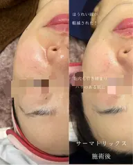 気になるフェイスラインやほうれい線に✨サロン版オリジオ💆‍♀️サーマトリックス首​〜​全顔＋LHA洗顔＋水光パック付き