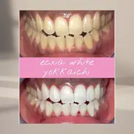 【定額通い放題プラン】セルフホワイトニング1ヶ月¥ 11000