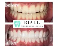 最高級プラチナセルフホワイトニング2来店分◀◁効果抜群