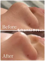 【ミニモ限定】毛穴エクストラクション美鼻コース⭐️ 《毛穴洗浄》