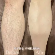 【清潔感UP】メンズ ひざ下脱毛 初回 ¥1,980