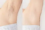 ワキつるつる脱毛💎脱毛デビューの方にオススメ✨