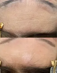 フェイシャル脱毛