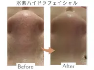 【リピート】水素ハイドラフェイシャル✨