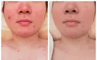 【初回お試し】なめらか肌に変身！ニキビ肌ケア フェイシャル