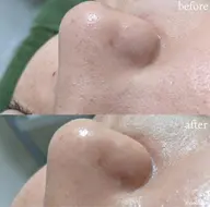 【💎ハイドロスキン💎】毛穴洗浄で全顔つるつる☺️💕小鼻の黒ずみに1回でわかる効果👀ご新規さま¥5,500