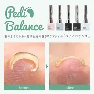 【オフ有り】巻き爪矯正コース(ペディバランス)