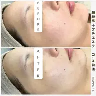 【毛穴引き締めも同時に叶う✨】レディース♡顔脱毛＋プチエステ付き