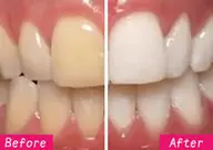美歯白💎セルフホワイトニング🦷✨60min照射し放題🪞
