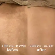 夏に大人気♥️背中＋うなじ脱毛✨シェービング無料🎶