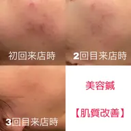 ☀️おすすめNo,3☀️【肌荒れ改善特化メニュー】W美容鍼(40本)+ヘッドマッサージ+首肩背中マッサージ