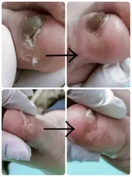 副爪(小指横爪の様な角質)1箇所5500円2箇所6600円