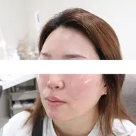 松ヤニパック×毛穴侍（全顔）で毛穴が綺麗になるコース