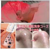 毛穴角栓洗浄吸引・黒ずみ対策ハイドラフェイシャル60分