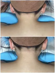 きらきらミニモ🌈うなじ&背中美人✨自分じゃなかなか処理できない⚡️みられて安心背中まるっと脱毛🌷