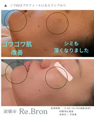 剥離あり/韓国ハーブピーリング|シミ・くすみ・たるみ・ニキビ肌✨韓国メディカルブランド使用¥16800→円13800