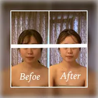 小顔矯正(モニター)×4回