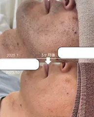 【ひげ脱毛】洗浄→毛穴角質ケア→吸引→脱毛照射→鎮静パック