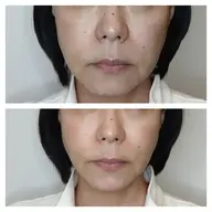 ✴️期間限定📣最新機器サーマトリックスで小顔💆ニキビ跡凹凸肌も改善✨シートマスク付き☝️