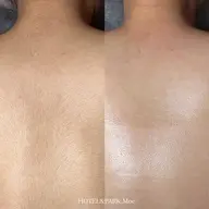 【VIO+背中上*うなじ込ワックス脱毛】