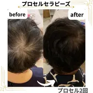 AGAに頼らない！【薄い毛でお悩みの方】結果重視/プロセルセラピーズ毛活促進